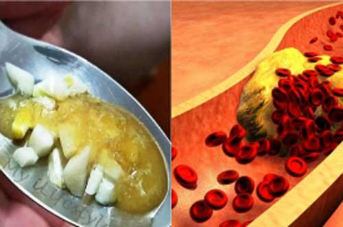 Bí quyết gia truyền của danh y: Diệt sạch mỡ máu với 4 củ tỏi + 4 quả chanh, công thức vô cùng đơn giản