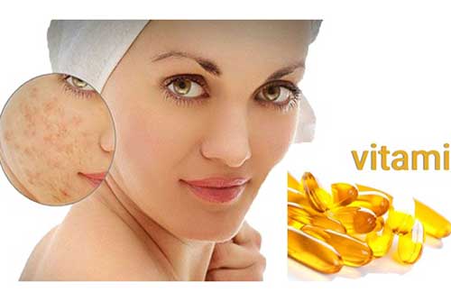 5 cách "đánh bay" sẹo rỗ, chỉ cần kiên trì da bạn sẽ láng mịn như ý