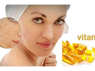 5 cách "đánh bay" sẹo rỗ, chỉ cần kiên trì da bạn sẽ láng mịn như ý