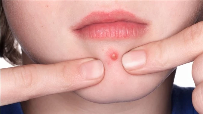 Củ ráy chữa bệnh gout đơn giản và nhanh chóng ngay tại nhà - Ảnh 4 cu ray chua benh gout 4