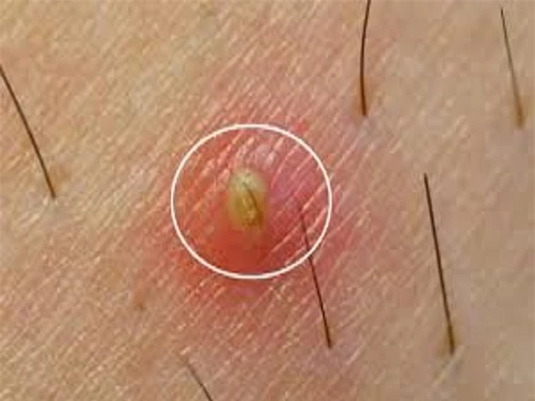 Viêm nang lông chân: Dấu hiệu, nguyên nhân và cách điều trị - Ảnh 3 Viem nang long chan 3