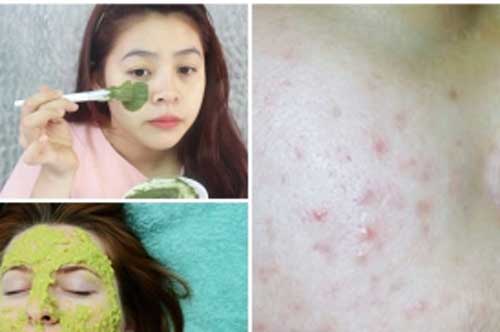Nguyên liệu rẻ tiền này chính là "thần dược" trị dứt điểm mụn ẩn