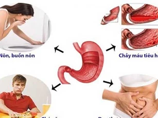 Những dấu hiệu cảnh báo đau dạ dày, rất nhiều người mắc bệnh mà không biết