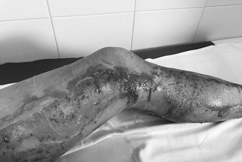 Cứu hai vợ chồng bị sét đánh khi đang làm đồng