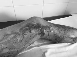 Cứu hai vợ chồng bị sét đánh khi đang làm đồng