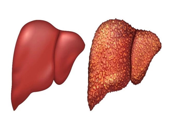 Viêm gan là bệnh do nhiều virus gây ra, phổ biến nhất là viêm gan A, B và C