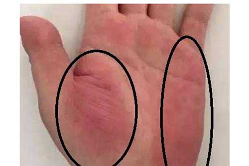 3 dấu hiệu trên tay cảnh báo sớm ung thư gan, có 1 trong 3 cũng nên đi khám ngay