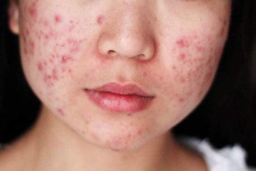 Làm gì để cải thiện trứng cá của tuổi dậy thì?