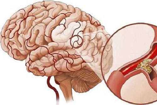 3 triệu chứng khó chịu khi ngủ cảnh báo bệnh nhồi máu não