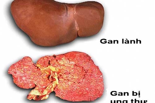 Ung thư gan rất nguy hiểm bạn cần chú ý dấu hiệu ban đầu nhận biết chúng.