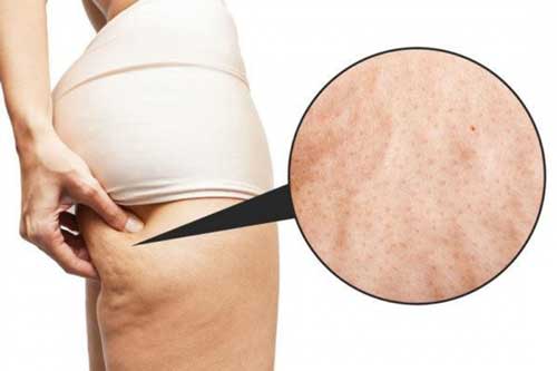 90% phụ nữ bị chứng da sần vỏ cam, chuyên gia "mách nước" điều trị hiệu quả