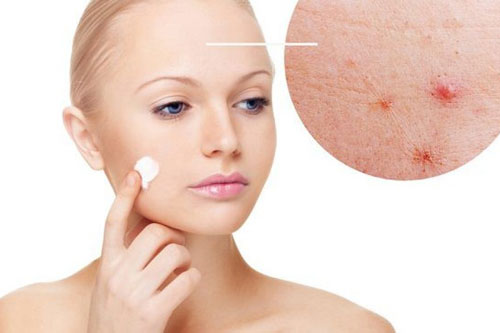 Những thực phẩm “đại kị” với người bị mụn trứng cá