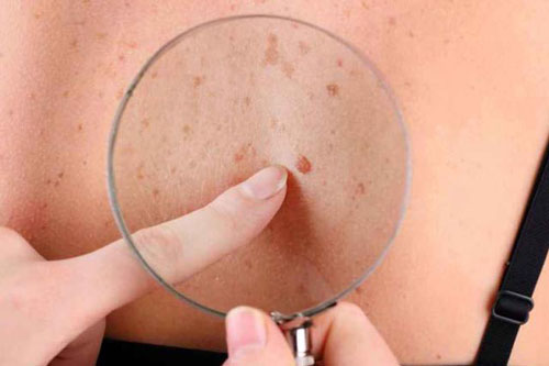 Nếu sắp bị ung thư, trên da sẽ cùng lúc có 4 dấu hiệu này