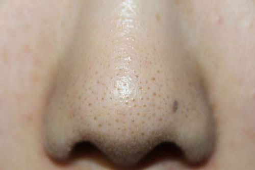 Chỉ với 1 quả chanh và 1 bát nước đá, bạn có thể đánh bay vĩnh viễn mụn cám, mụn đầu đen