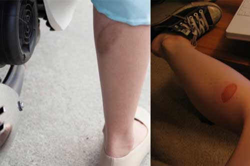 Cách chữa bỏng bô an toàn, hiệu quả nhất và không để lại sẹo