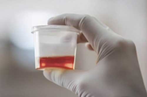 Nhiều trẻ đến viện vì nước tiểu đỏ như máu, bác sĩ lý giải nguyên nhân bất ngờ khiến gia đình "thở phào"