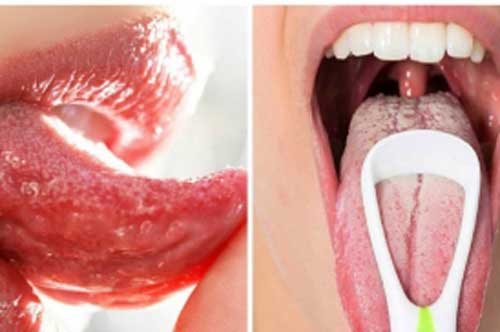 Nhìn vào lưỡi 5 giây: Thấy có màu này cảnh báo bệnh ung thư, viêm phế quản nặng, cần đi khám ngay