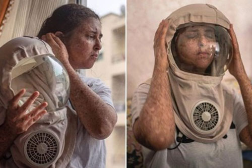 Cô gái đội "mũ phi hành gia" trong suốt 20 năm vì dị ứng với tia UV