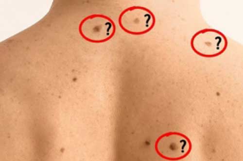 5 dấu hiệu "lạ" trên da cảnh báo ung thư và nhiều bệnh nguy hiểm khác, đặc biệt là số 2