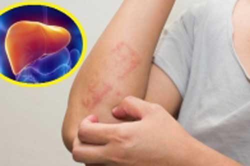 5 biểu hiện chứng tỏ gan đang rất "nóng", cần thải độc càng sớm càng tốt