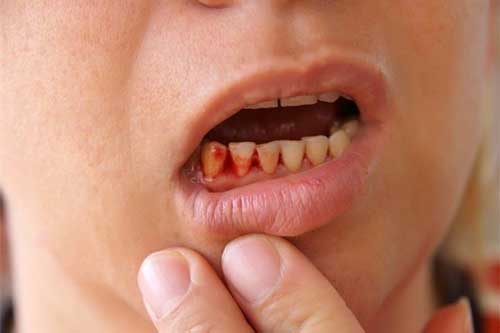 Mối hiểm họa không ngờ từ những chiếc tăm tre không phải ai cũng biết