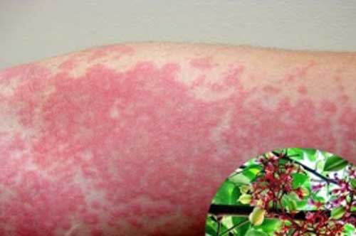 3 bài thuốc trị tận gốc dị ứng, mề đay đang được săn lùng nhất trong thời gian qua
