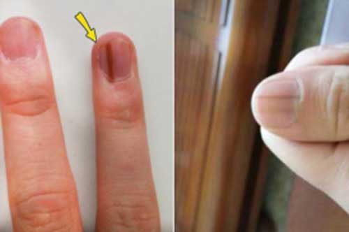 7 dấu hiệu khác thường trên móng tay cảnh báo bệnh nguy hiểm, đặc biệt là số 3
