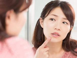 Top 5 cách trị mụn ẩn trên trán tại nhà, giúp nhân tự trồi lên không cần nặn