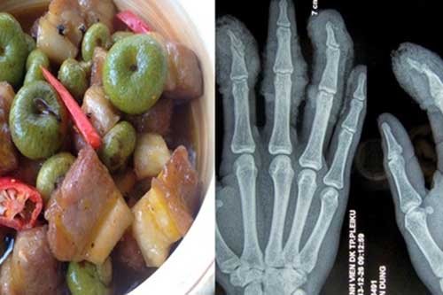 Khỏi tiệt cơn đau khớp với bài thuốc quý từ quả sung hầm thịt nạc