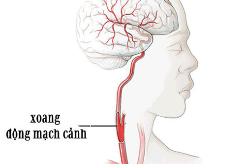 Cô dâu đột tử vì chú rể hôn vào xoang động mạch cảnh trên cổ, 4 điểm trên cơ thể tránh tác động mạnh