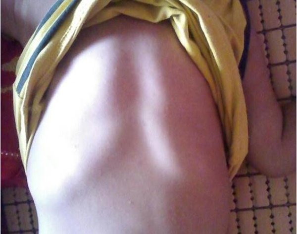 Con gái xương ngực như "ức gà", mẹ trẻ hối hận vì nghe mẹ chồng nuôi con sai cách