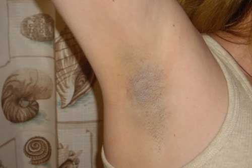 Hôi nách cỡ nào cũng hết chỉ bằng một mẹo đơn giản