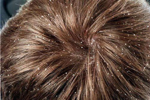 Rụng tóc, gàu và nấm da đầu - Bệnh gì?