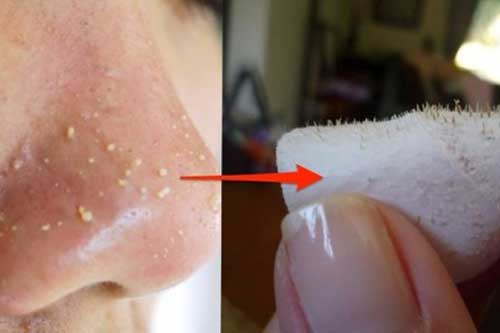Sạch mụn đầu đen trên mặt chỉ với 1 quả trứng gà