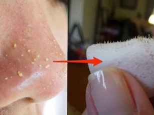 Sạch mụn đầu đen trên mặt chỉ với 1 quả trứng gà