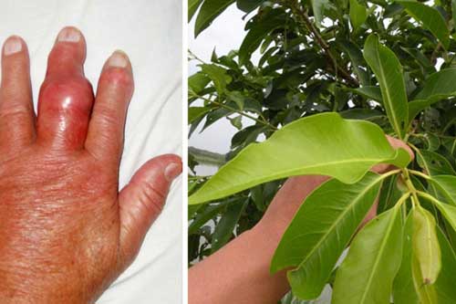 Khỏi hẳn bệnh gout kinh niên chỉ sau 1 tháng bằng thứ nước uống cực rẻ tiền và dễ làm này