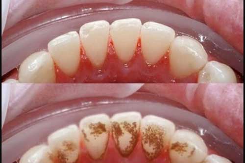 Sạch cao răng vĩnh viễn nếu dùng 1 thìa sữa chua đúng cách