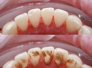 Sạch cao răng vĩnh viễn nếu dùng 1 thìa sữa chua đúng cách