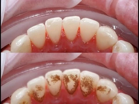 Vôi răng hay còn gọi là cao răng là mảng bám đã cứng lại trên răng.