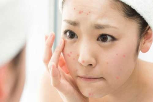 Bật mí cách "đánh bay" mụn bọc cho làn da mịn màng, xinh tươi
