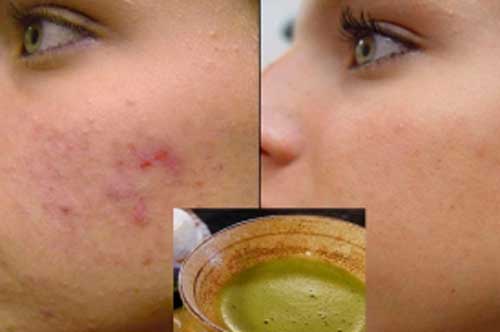 Chăm bôi thứ này lên mặt trong 1 tuần đảm bảo hết mụn, da mịn màng trắng sáng tự nhiên