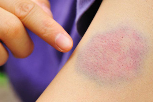 Dấu hiệu sớm của bệnh ung thư máu nhiều người bỏ qua