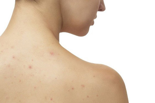 Đây là những cách bạn có thể khắc phục khi thấy lưng xuất hiện mụn