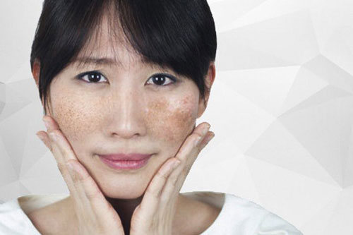 7 loại mặt nạ trị nám, đắp đến đâu da tự khắc trắng hồng đến đó, hết sạch thâm sạm