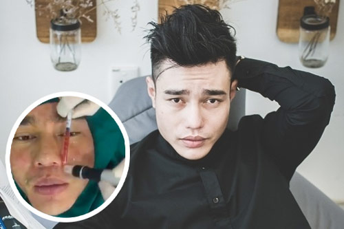 Lê Dương Bảo Lâm hé lộ sự cố "dao kéo" gây sốc: "Bạn tôi nhìn thấy máu vương đầy mặt tưởng tôi chết mới la lên"