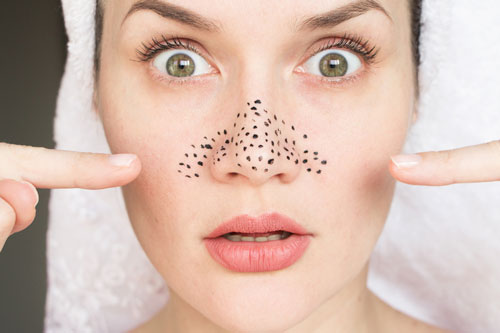 Bí quyết chăm sóc da giảm mụn đầu đen và mụn bọc