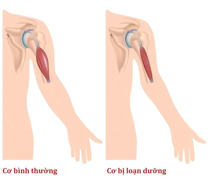 4 căn bệnh dễ di truyền cho nam hơn nữ, vợ chồng nếu mắc phải nên mong sinh con gái - Ảnh 5