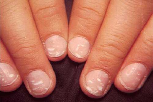 Nếu móng tay xuất hiện những đặc điểm này thì hãy cẩn thận với gan của bạn