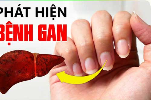 Điểm "lạ" trên cơ thể cảnh báo gan đang dần "nhàu nát" mỗi ngày, hãy nhanh chân đi gặp bác sĩ