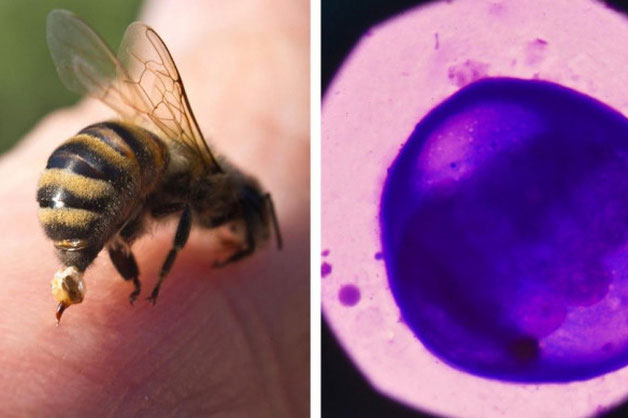 Nọc ong mật có thể tiêu diệt tế bào ung thư vú ác tính